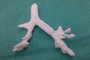 3D printed Tracheal Implant