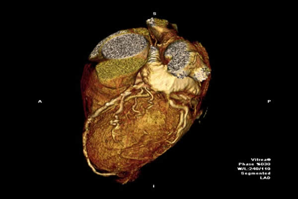 3D MRI of the heart