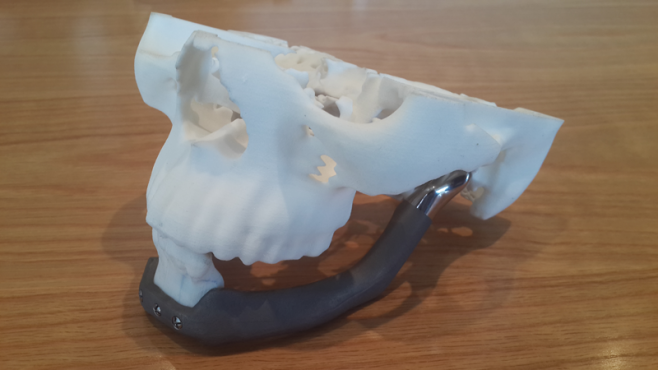 3D printed Jawbone
