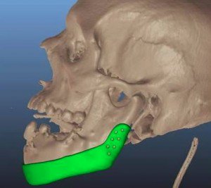 3D printed jaw for war victim