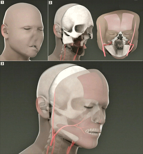 3D printed face transplant process