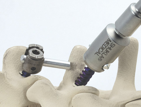 Shukla Medical designs and manufactures universal orthopedic implant removal tools such as the Xtract-All® Spine Universal Spinal Implant Removal System (above)
